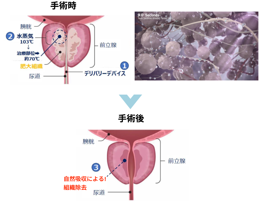 前立腺水蒸気治療（WAVE）治療イメージ